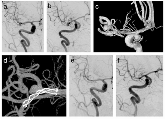 cerebral aneurysm {faces}